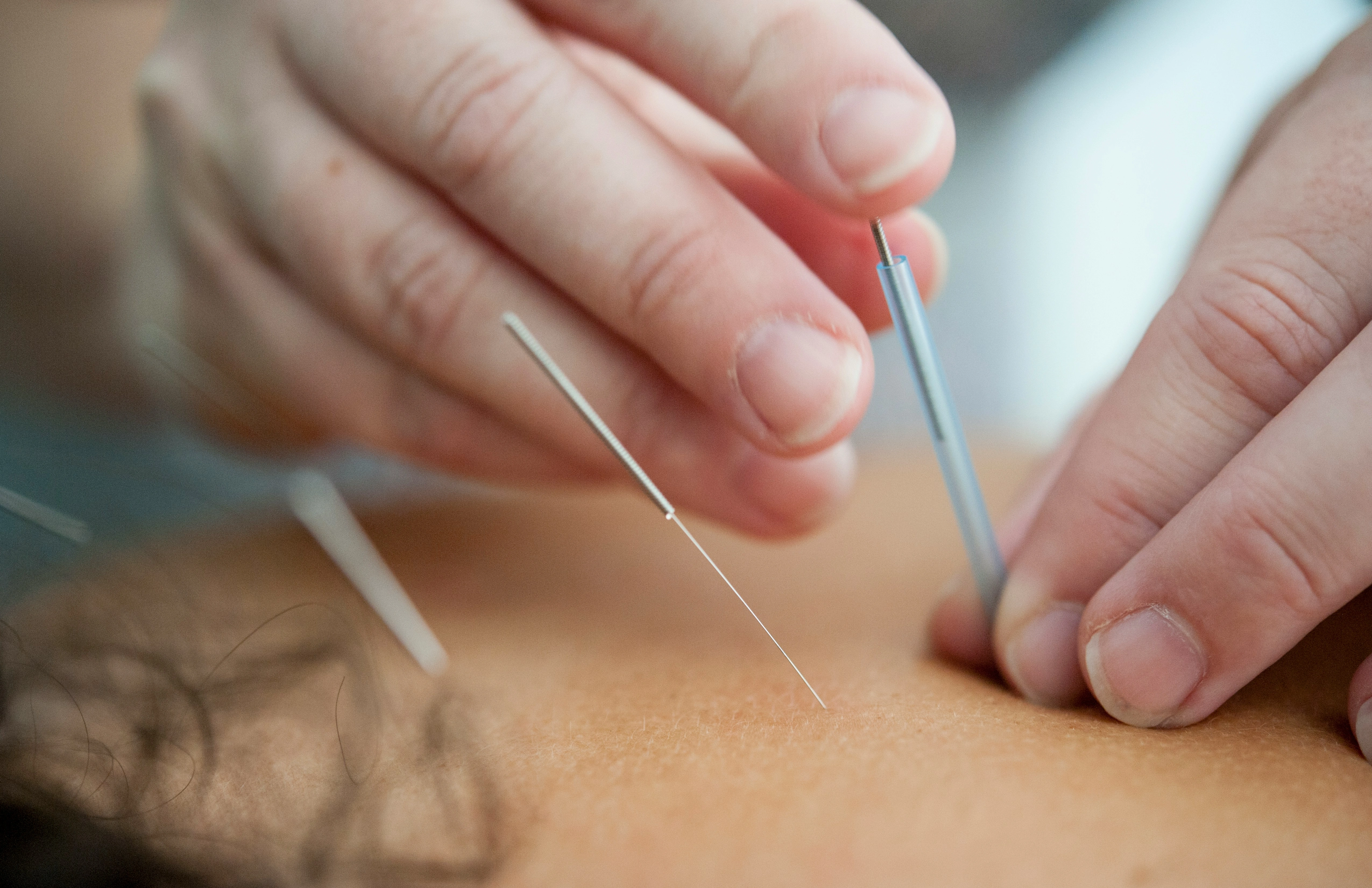Acupuncture treatment in Noosa