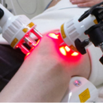 Knee irradiation with the super pulse laser